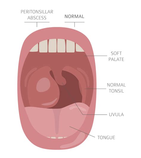 Throat Hurts on One Side: 12 Causes, Treatments