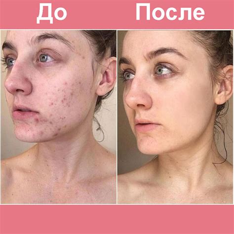 Акне Картинки На Лице – Telegraph