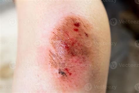 Bruised wound injury on woman knee background 9236077 Stock Photo at ...