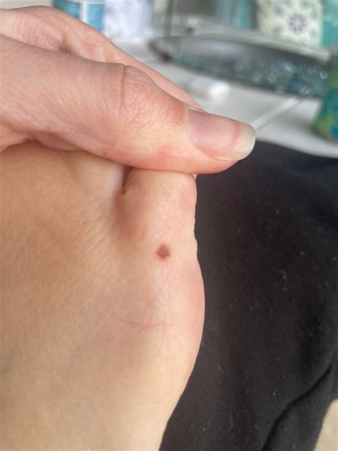 Melanoma