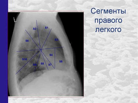 Рентгенанатомия грудной клетки - презентация онлайн