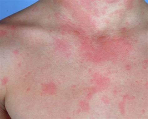 rash  urticaria  kathryn martin blog
