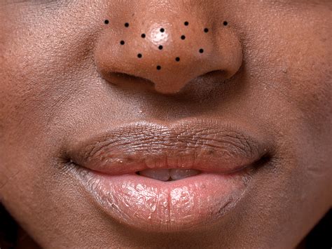 Forget Everything You Know: Unbelievable Blackhead Removal 2024 Revealed - oaurmxr