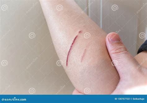 Deep Skin Cut