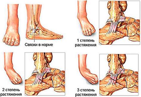 Растяжение связок голеностопный сустав – Растяжение связок ...