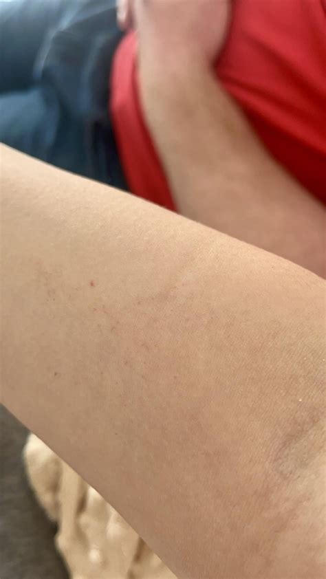 Broken blood vessels? : r/DiagnoseMe
