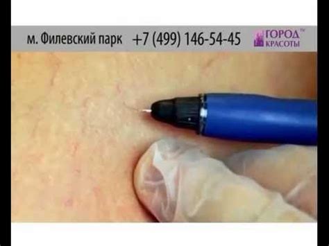 Удаление сосудистой сетки - быстро и навсегда! - YouTube