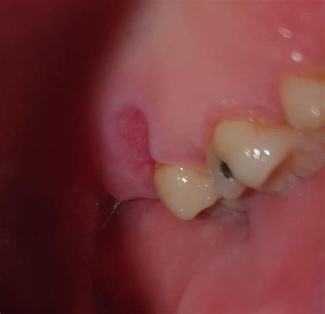 Canker Sores