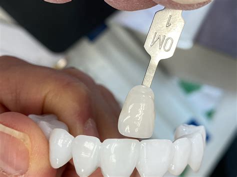 Advanced Ceramics Dental Lab at Bennie Feeney blog