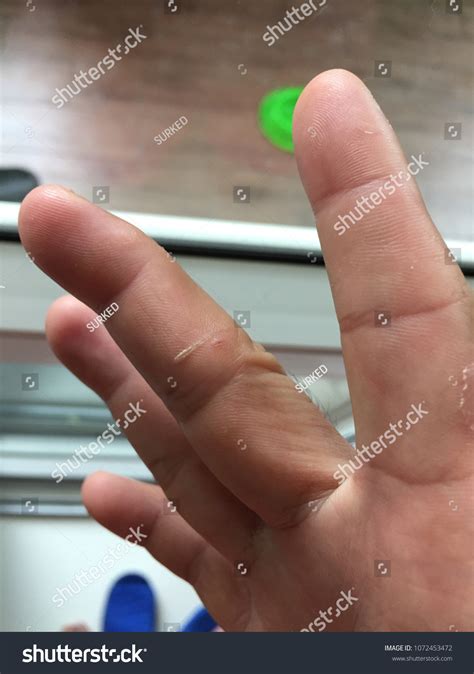 Scar On Index Finger Right Hand Stock Photo 1072453472 | Shutterstock