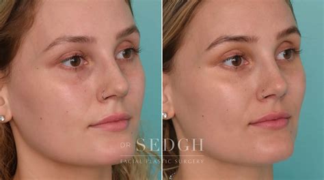 Tear Trough Filler Before and After Photos | Dr. Jacob Sedgh