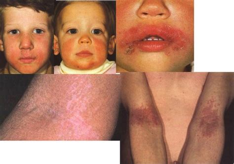 Types of Dermatitis Flashcards | Quizlet