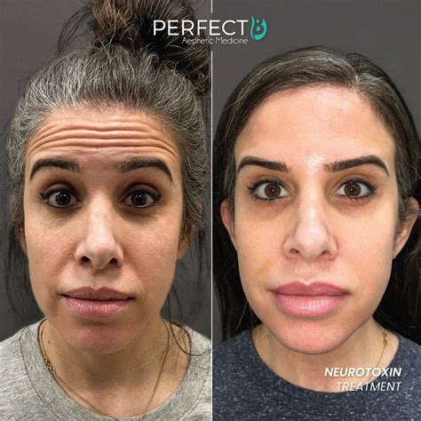 Neurotoxin Treatment - Perfect B