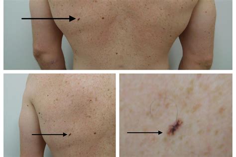 What does melanoma in situ look like | Symptoms and pictures