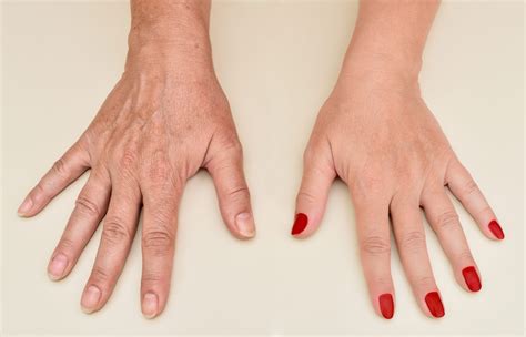 Hand Rejuvenation: Youthful Hands Awaits — Freyja Medical