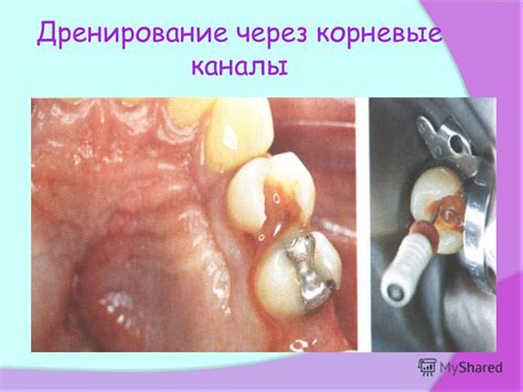 Презентация на тему: "ВРЕМЕННОЕ ПЛОМБИРОВАНИЕ КОРНЕВЫХ КАНАЛОВ ...