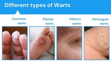 Warts - Causes, Symptoms, Diagnosis, and Treatment