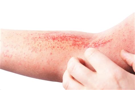 Contact Dermatitis - Sergio Mazzei