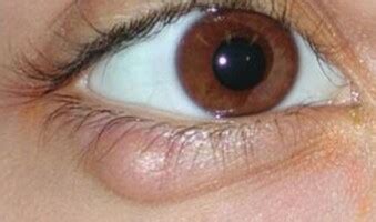 Swollen Eyelid Home Remedies, Cure Upper and Lower Swollen Eyelids ...