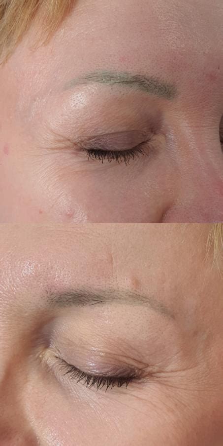 Permanent Make-Up Remover (PMU removal) - BUTTERFLY EFFECT