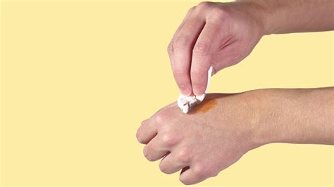 Yodo: el aliado perfecto para curar heridas