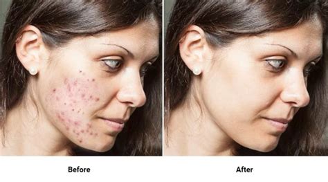 Accutane Side Effects: Isotretinoin Facts & Treatment Preparation