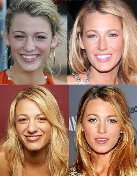 Blake Lively Rhinoplasty Before And After