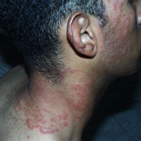 ringworm face - pictures, photos