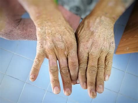 Scleroderma: What You Need to Know – ActiveBeat – Your Daily Dose of ...