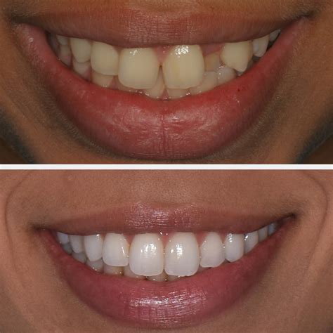 aligners    clear aligners