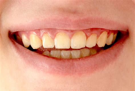 Pod Amarela Os Dentes - Dentes amarelados: por que isso acontece e o que pode ser feito ...