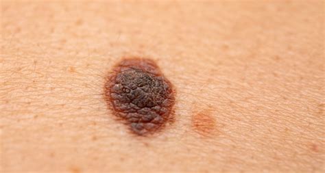 Mehr Fälle von malignen Melanomen