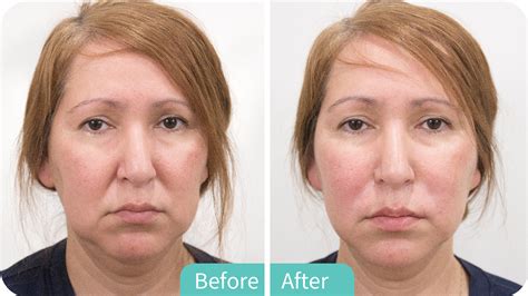 Radiesse Plus Filler | AMCC BEAUTY