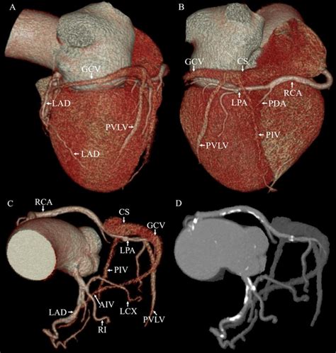 Coronary Artery Anatomy Ramus