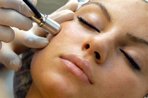 Florence’s Recommendation: Benefits of a Microdermabrasion Treatment ...