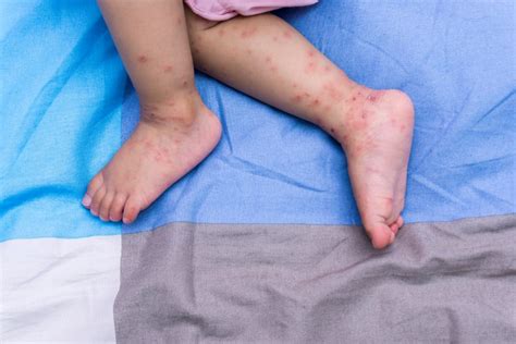 HFMD Signs and Symptoms, Causes, Treatment - Hello Doctor