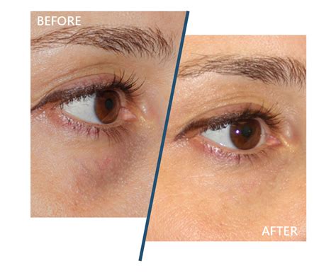 eye enhancements