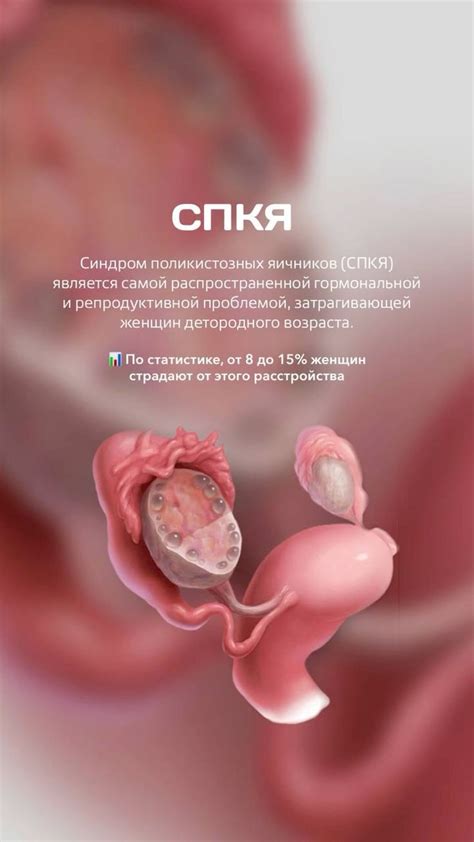 Сторис гинекология | Синдром поликистозных яичников, Товары для ...
