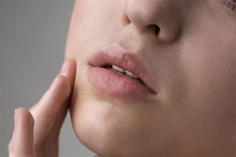 Liszaj wokół ust: objawy, rozpoznanie i domowe sposoby leczenia