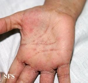 The Mysterious Case Of The Itch In The Left Palm Uncovering The Science And Possible Causes