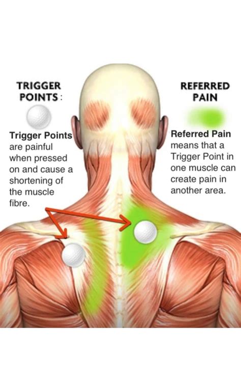 trigger point therapy