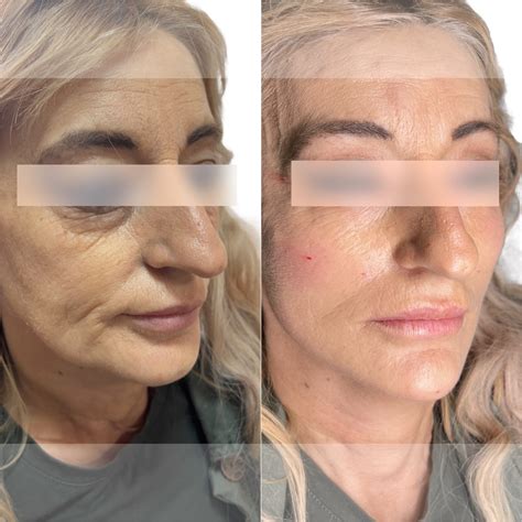 #FULLFACE - д-р Керимов - Естетична клиника