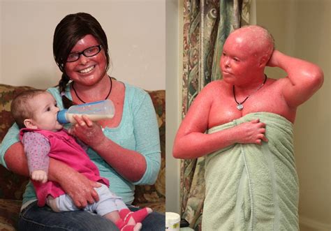 Harlequin Ichthyosis Stephanie Turner