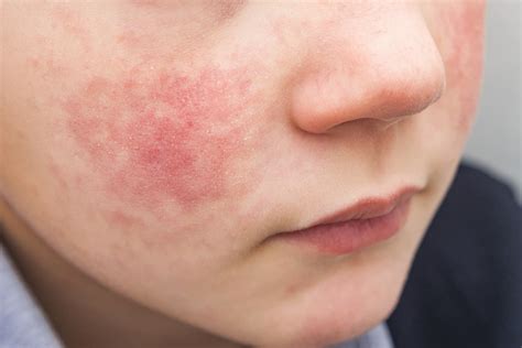 Eczema - MySkinDoctor