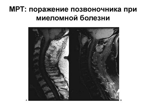 Миеломная болезнь (множественная миелома, болезнь Рустицкого-Калера ...