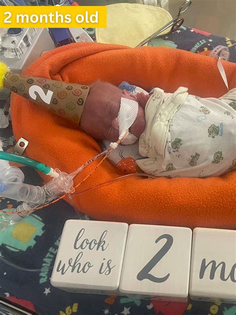 Iowa boy born at 21 weeks is now world's most premature baby | Stories