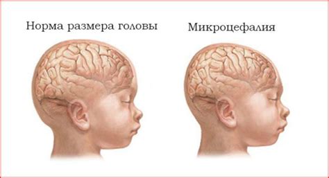 Синдром Альперса: признаки наследственной болезни, варианты помощи и ...