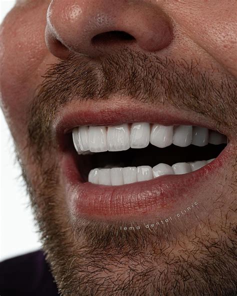 Dental Veneers Turkey - Lema Dental Clinic 2024