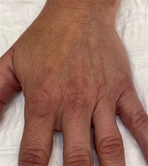 BBL Treatments | Laser Clinics Australia