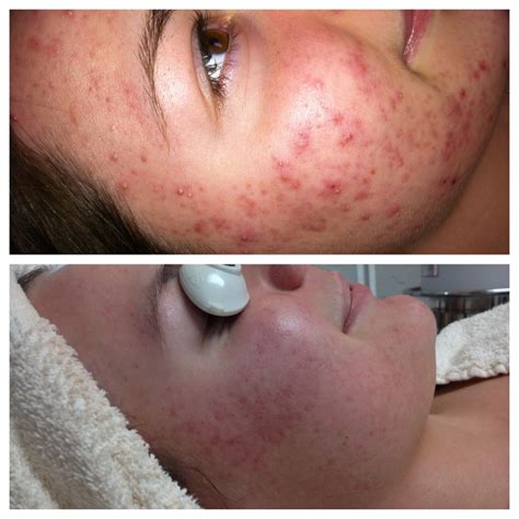 Before and After Inflamed Acne | Acne, Nose ring, Nose